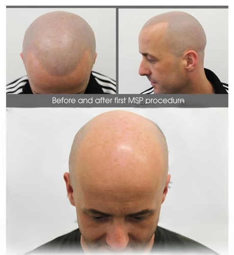Hair Transplant